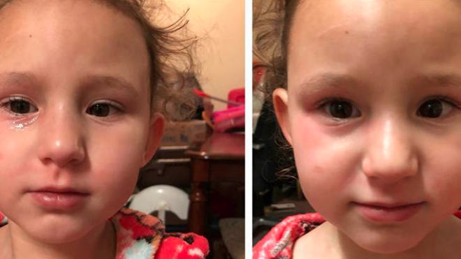 Pink eye breast milk