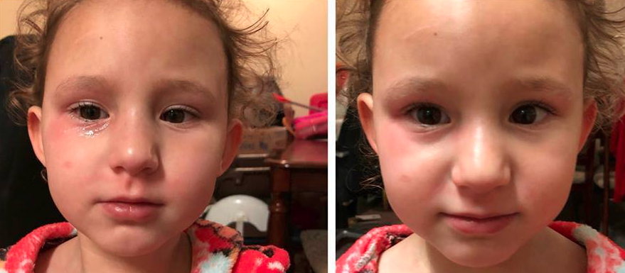 Pink eye breast milk