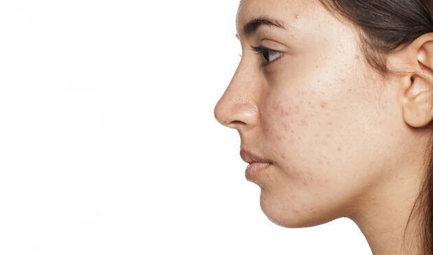 zits