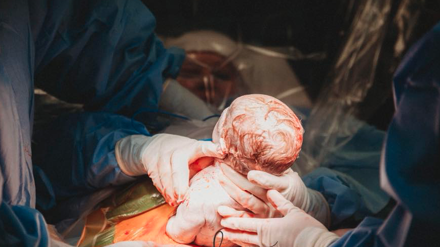 C-section delivery