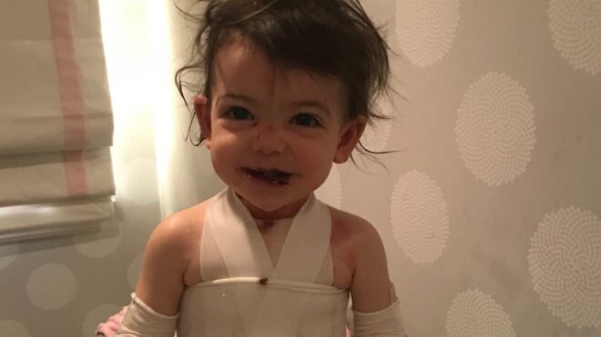 toddler with rare skin disease covered in wounds