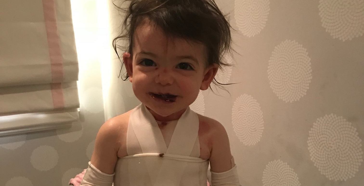 Rare Skin Condition Leaves Toddler  Covered in Wounds  - 74