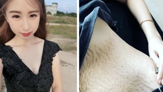 mom stomach with stretch marks