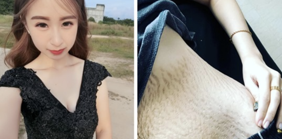 mom stomach with stretch marks