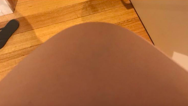 Abdominal separation during pregnancy