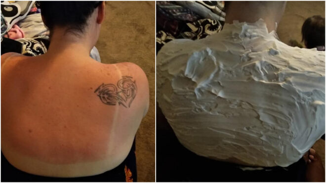 shaving cream sunburn hack