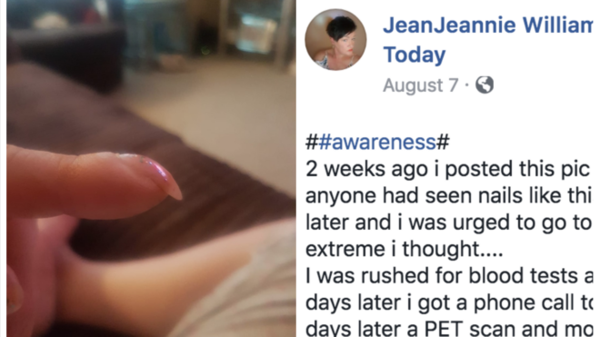 woman's fingernail cancer symptom