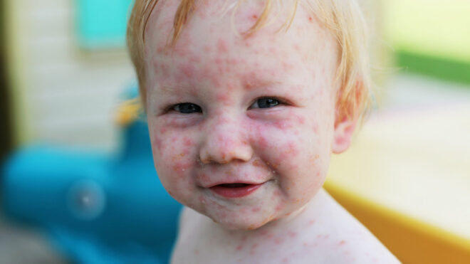 Chickenpox