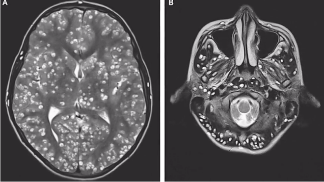 tapeworm in brain