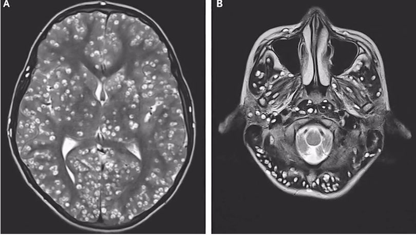 tapeworm in brain