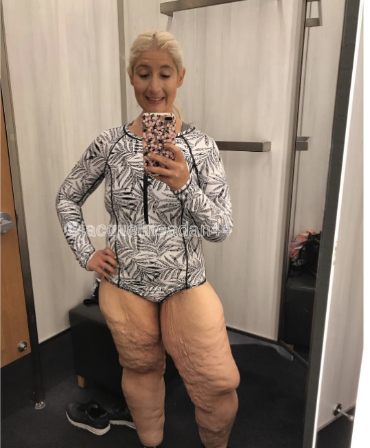 This Woman Refuses to be Ashamed of Her Loose Skin - 13