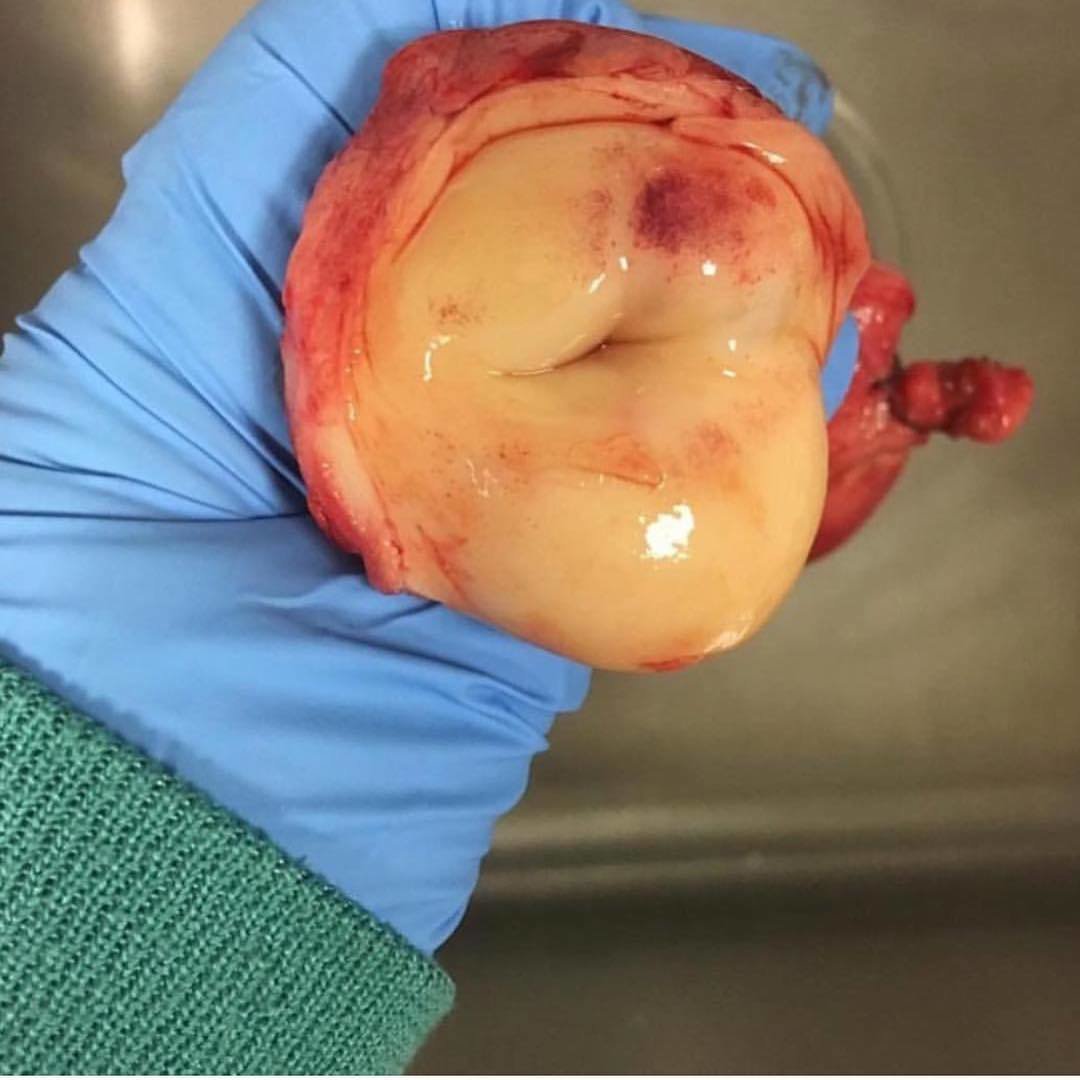 Cervix