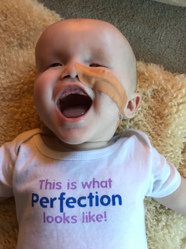 Baby born without eyes