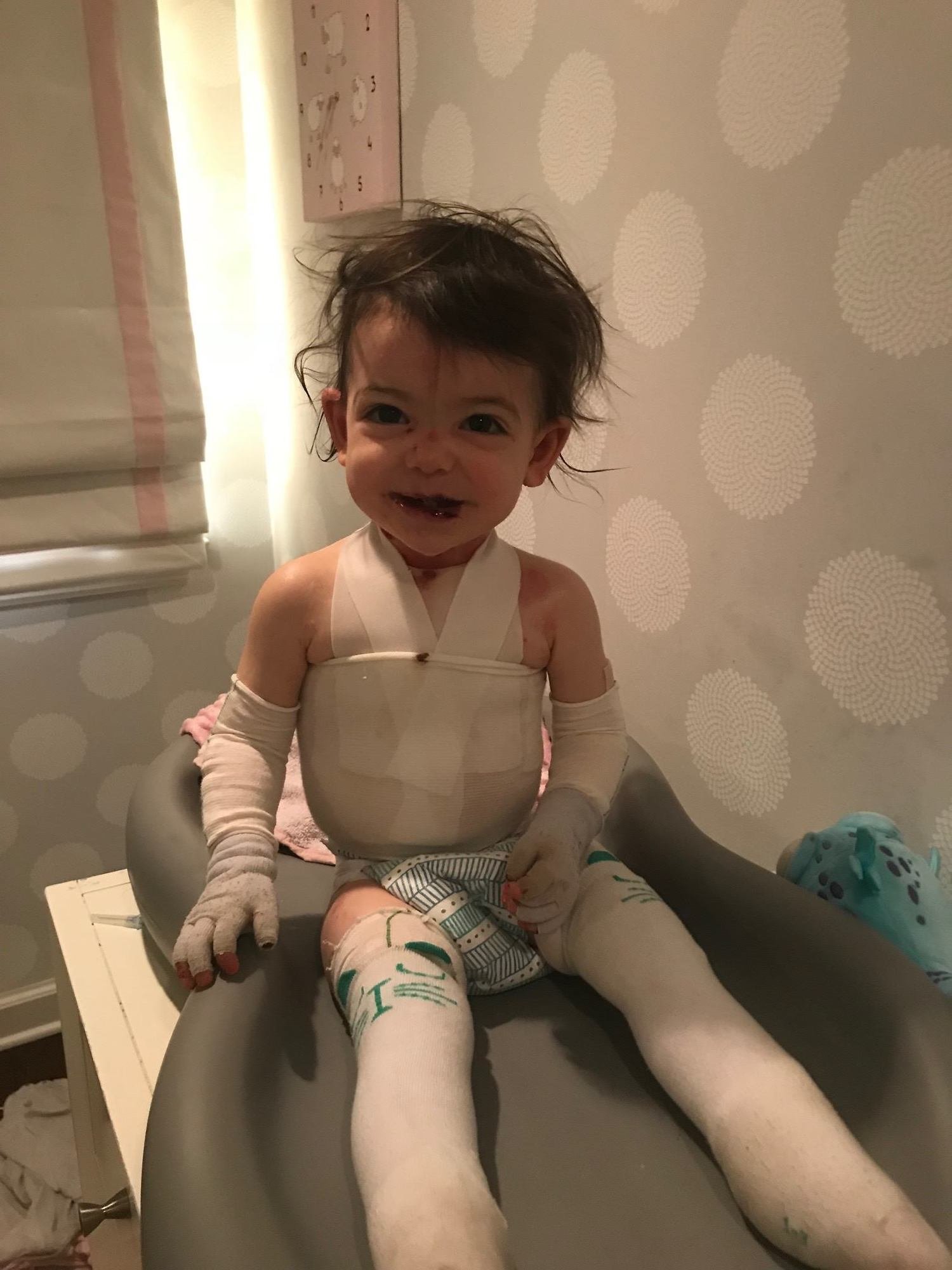 toddler with rare skin disease covered in wounds