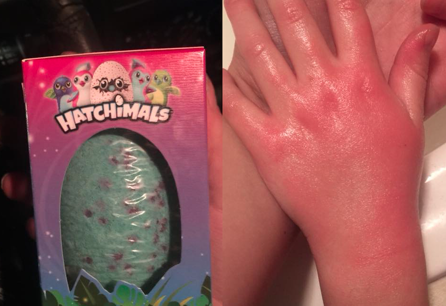 Hatchimal chemical burn