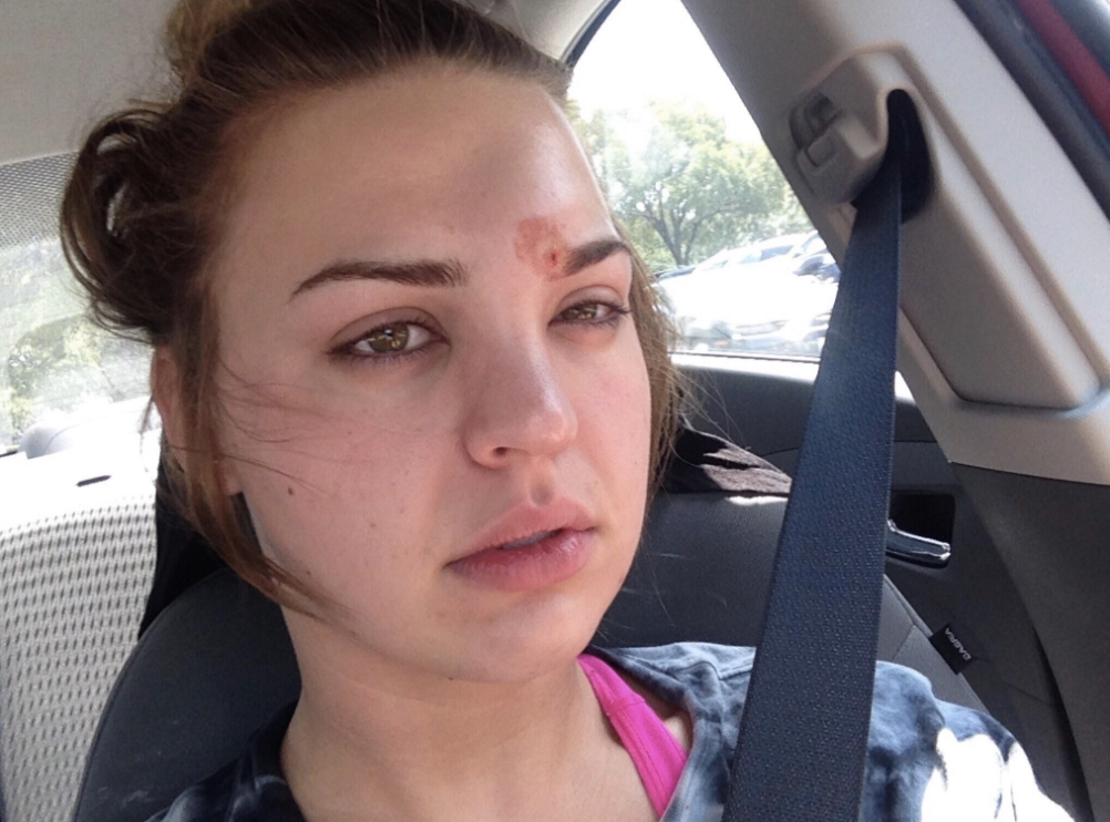 Staph Infection Makeup