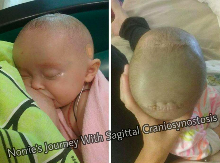 Baby breastfeeding after skull surgery 