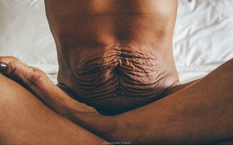 Postpartum post-baby belly