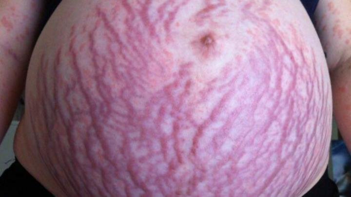 pregnancy belly rash