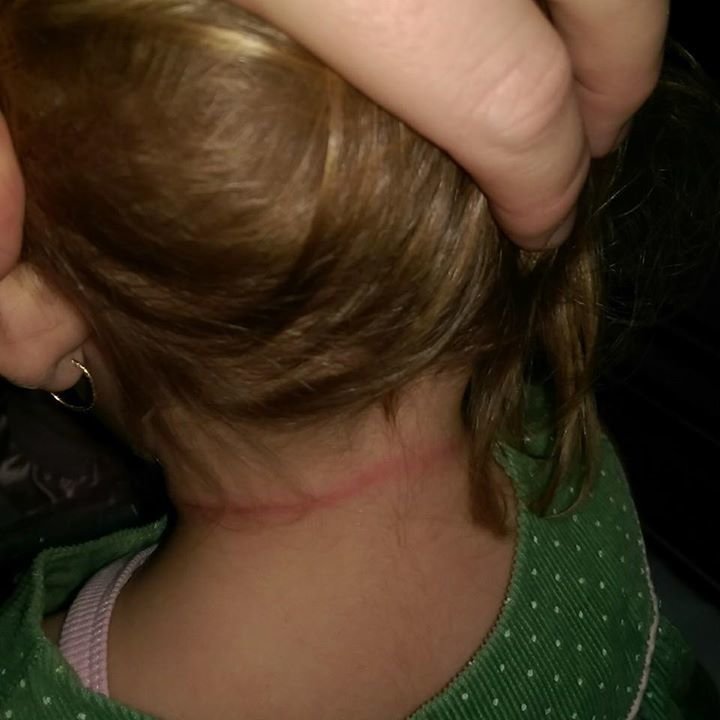 hair strangulation