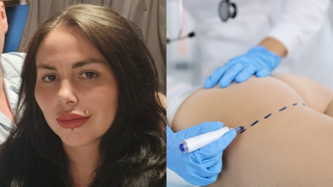 side by side of Alice Webb and a pair of medical gloved hands drawing on a woman's butt