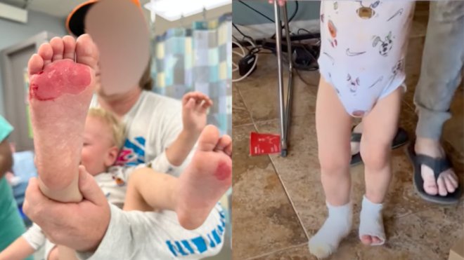 Toddler with second-degree burns on his feet