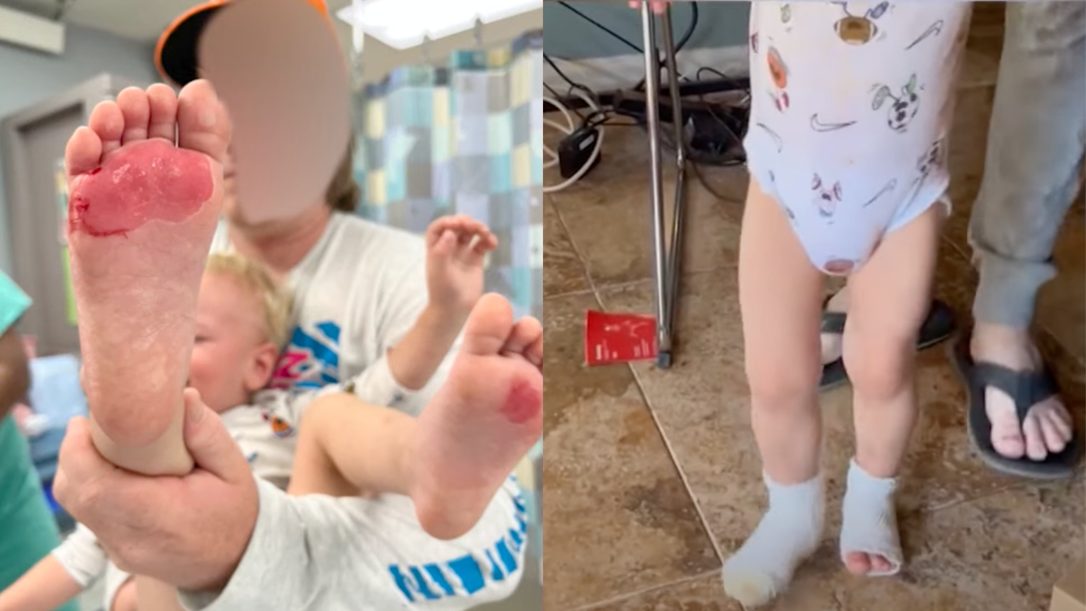 Toddler with second-degree burns on his feet