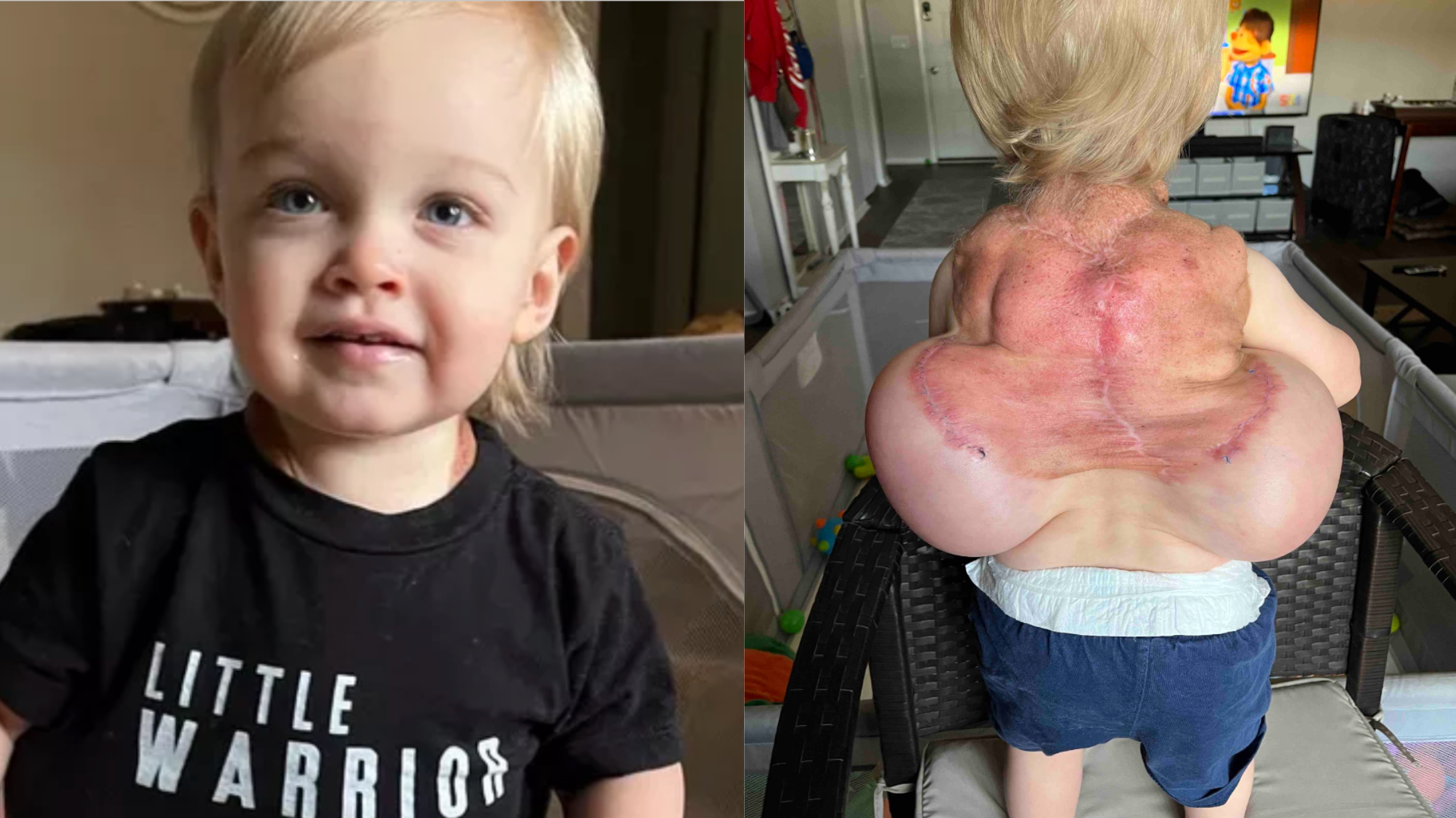 Little boy with back growth