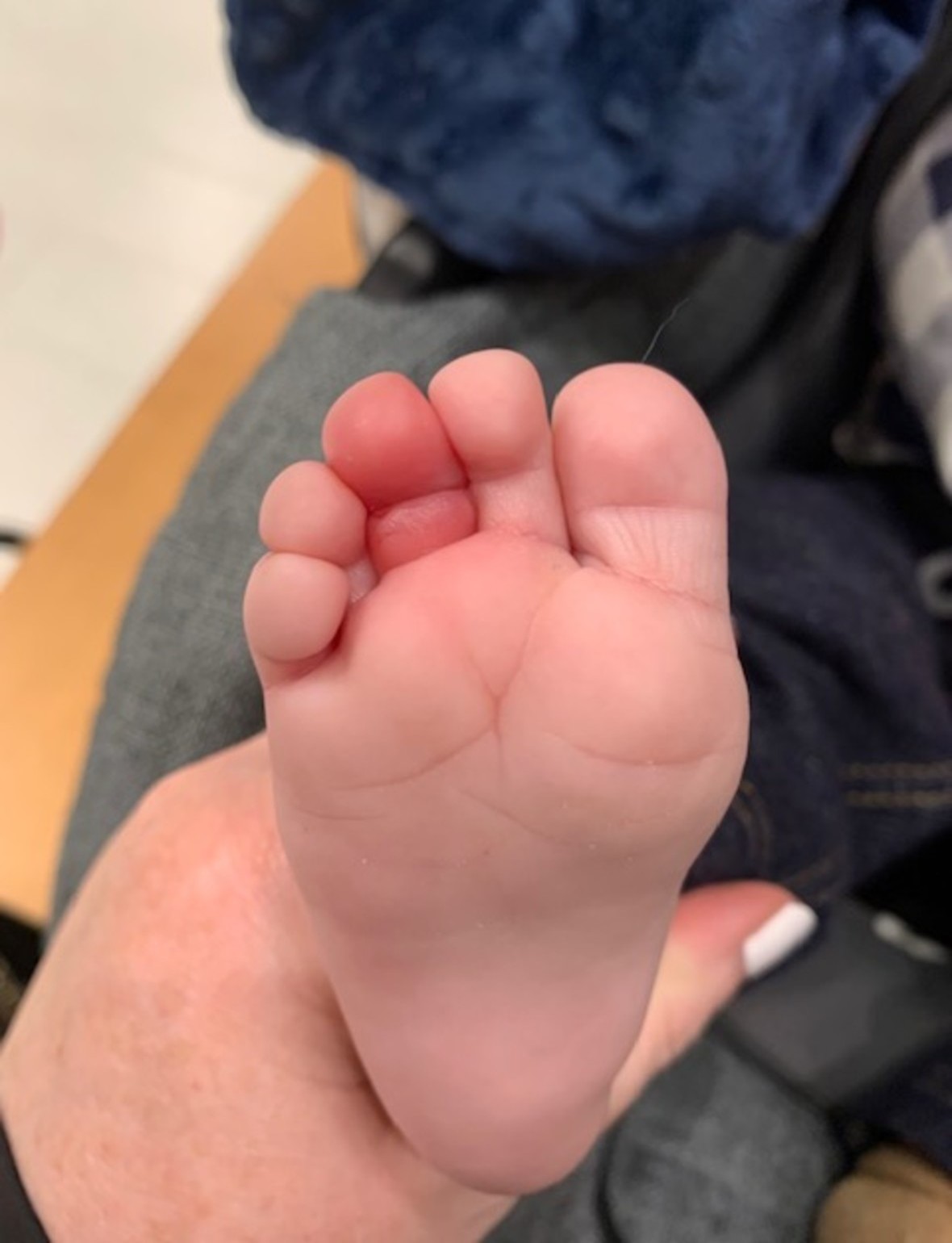 Logan_toe_-_back.jpg