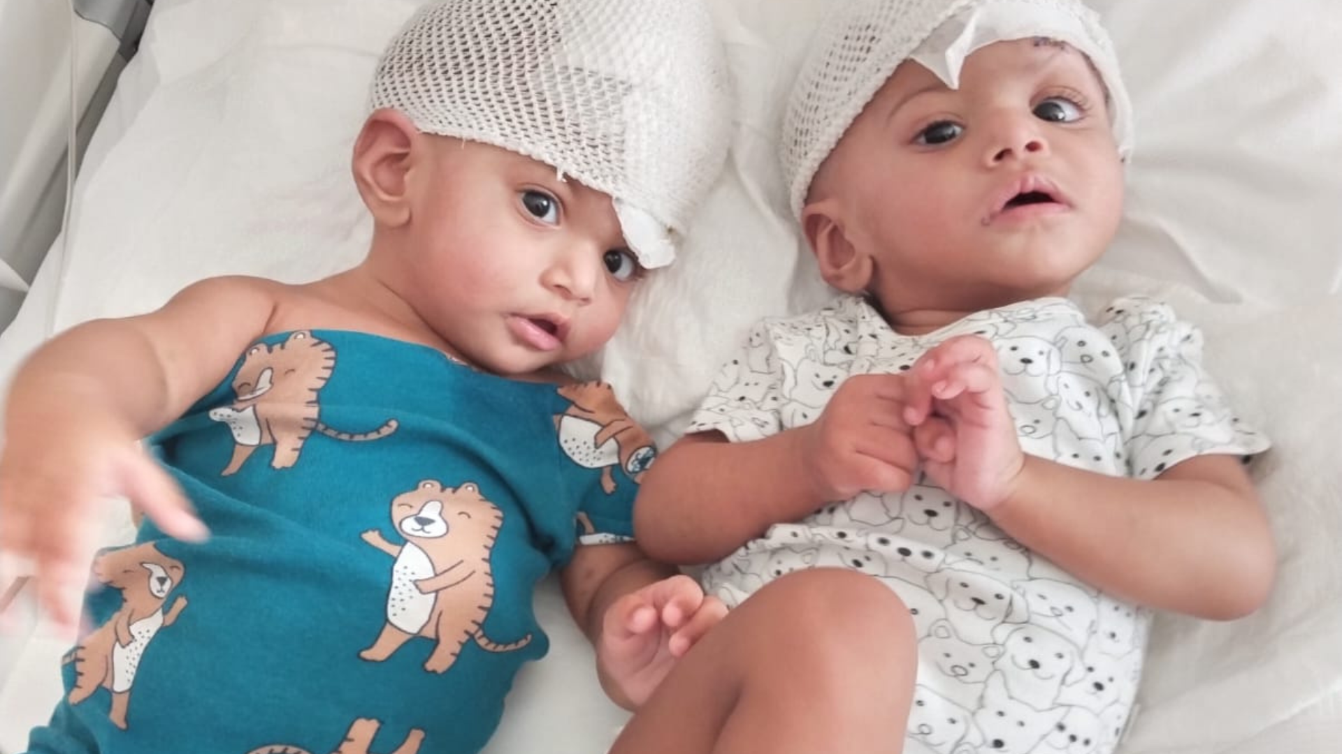 Mirha and Minal separated in a hospital bed