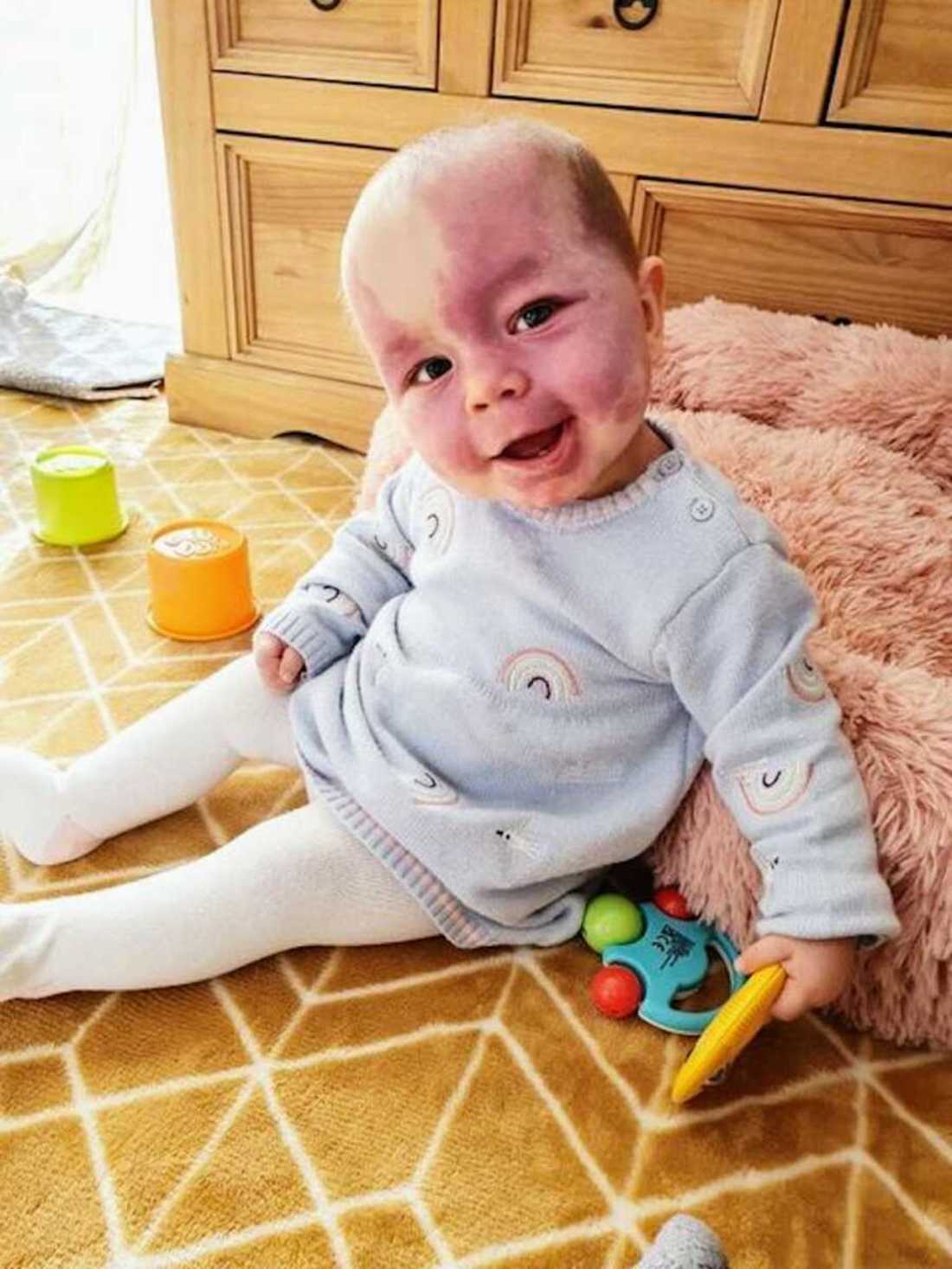 alice_and_dan_sturge_weber_syndrome_lwm10-900x1200-1.jpeg