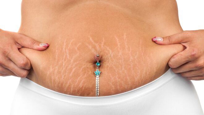 Stretchmarks