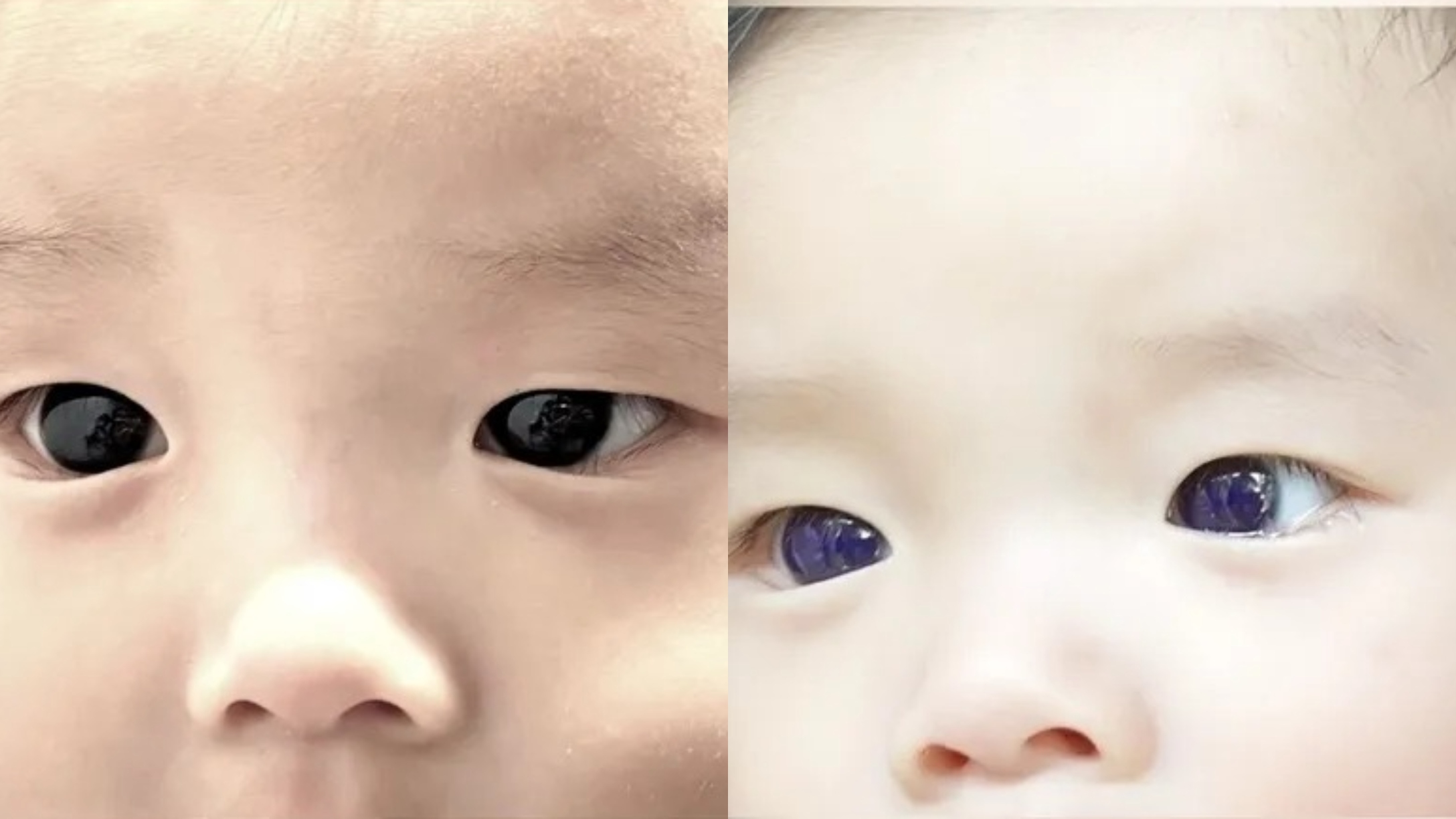 blue eyes covid-19 treatment