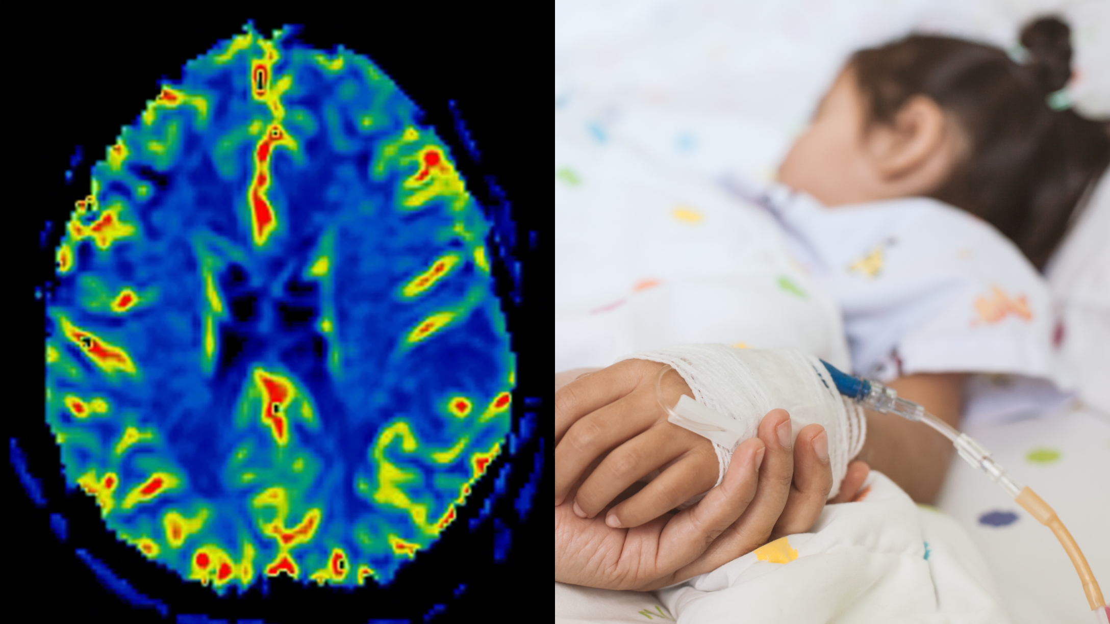 Brain Abscess