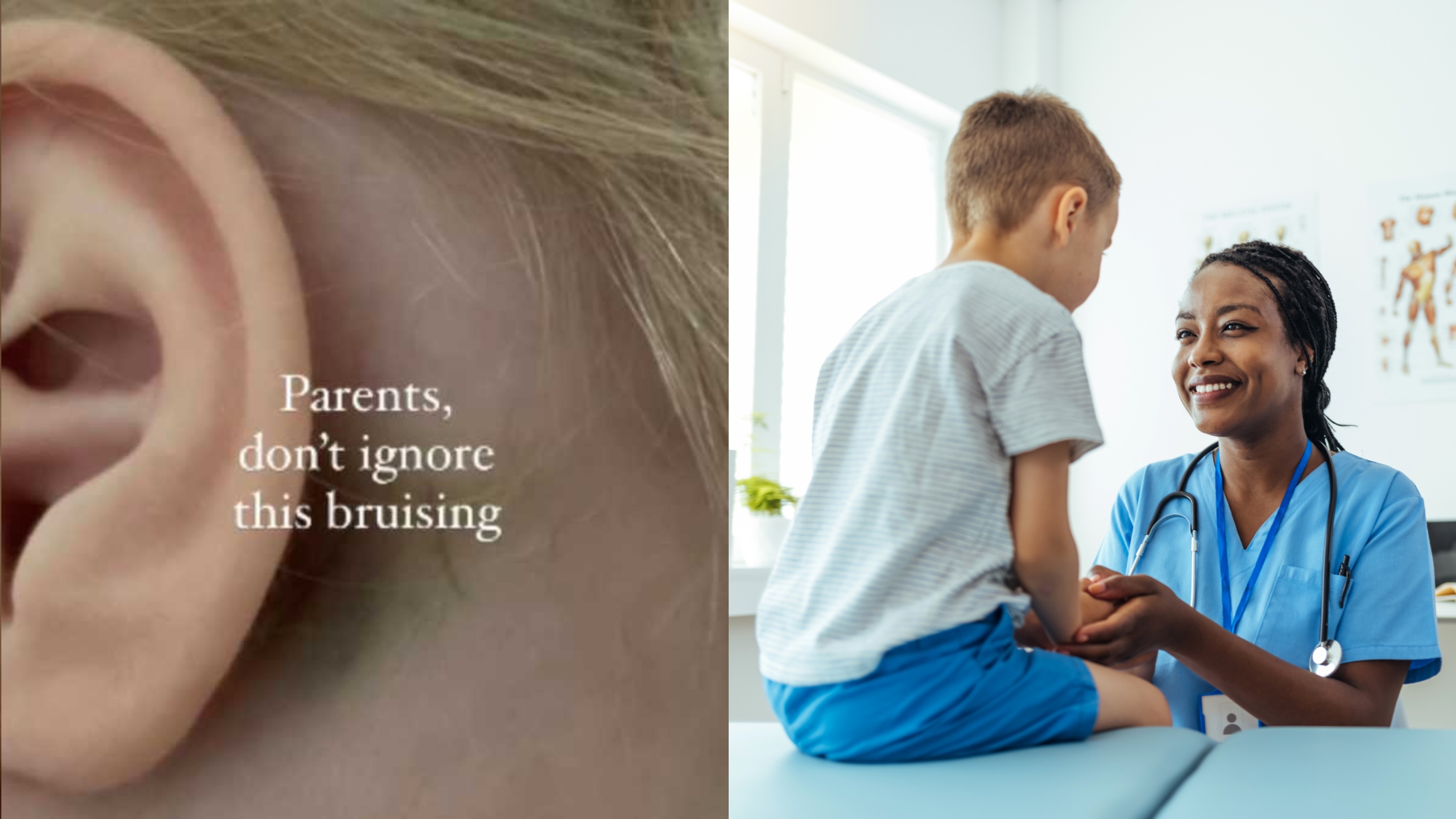 battle sign bruise
