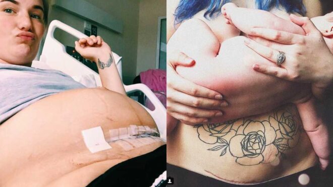 c-section scars