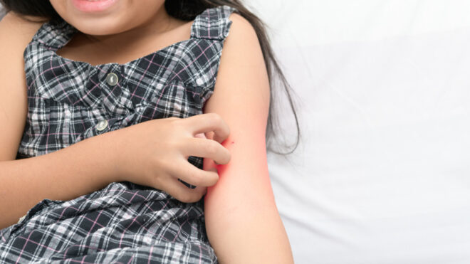 eczema flare-up