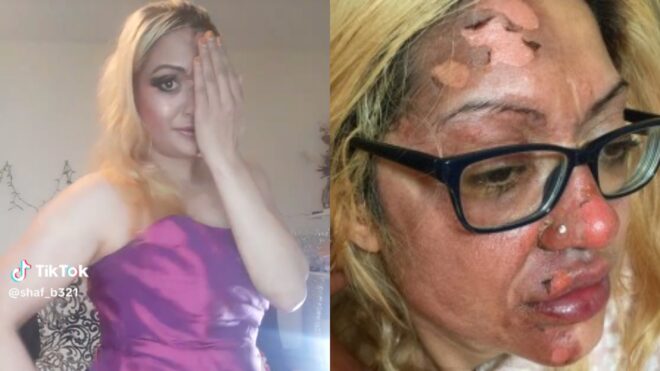TikTok Mom scalded by microwaved egg