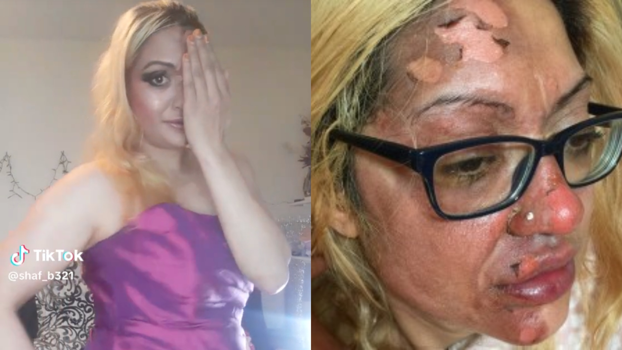 TikTok Mom scalded by microwaved egg