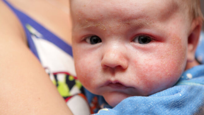 mom holding baby with eczema all over face