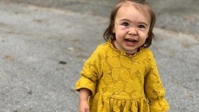 child whose face was bitten by dog