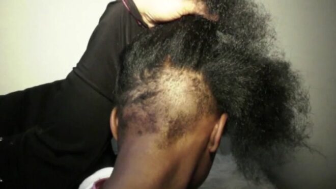Yamina Zahir lifts her daughter's hair to show a large patch of missing hair in the back.