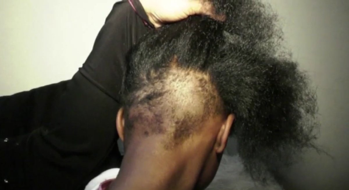 Yamina Zahir lifts her daughter's hair to show a large patch of missing hair in the back.