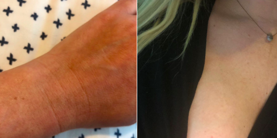 Twitter user shares photos of her wrist and boob freckle.