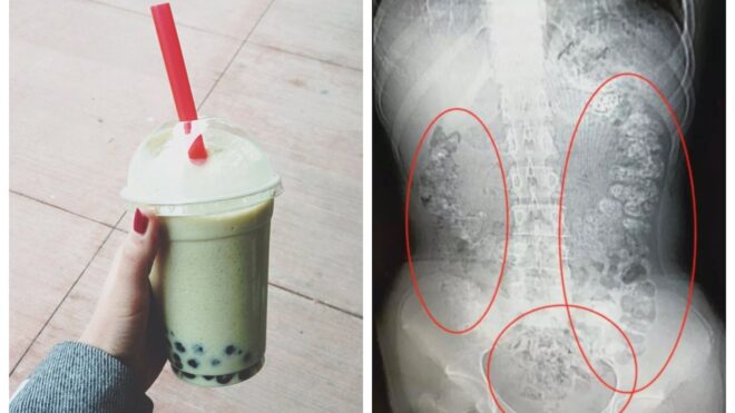 Bubble tea X-Ray