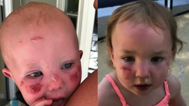 Two of Gribble's children appear with chemical burns that have blistered and peeled.