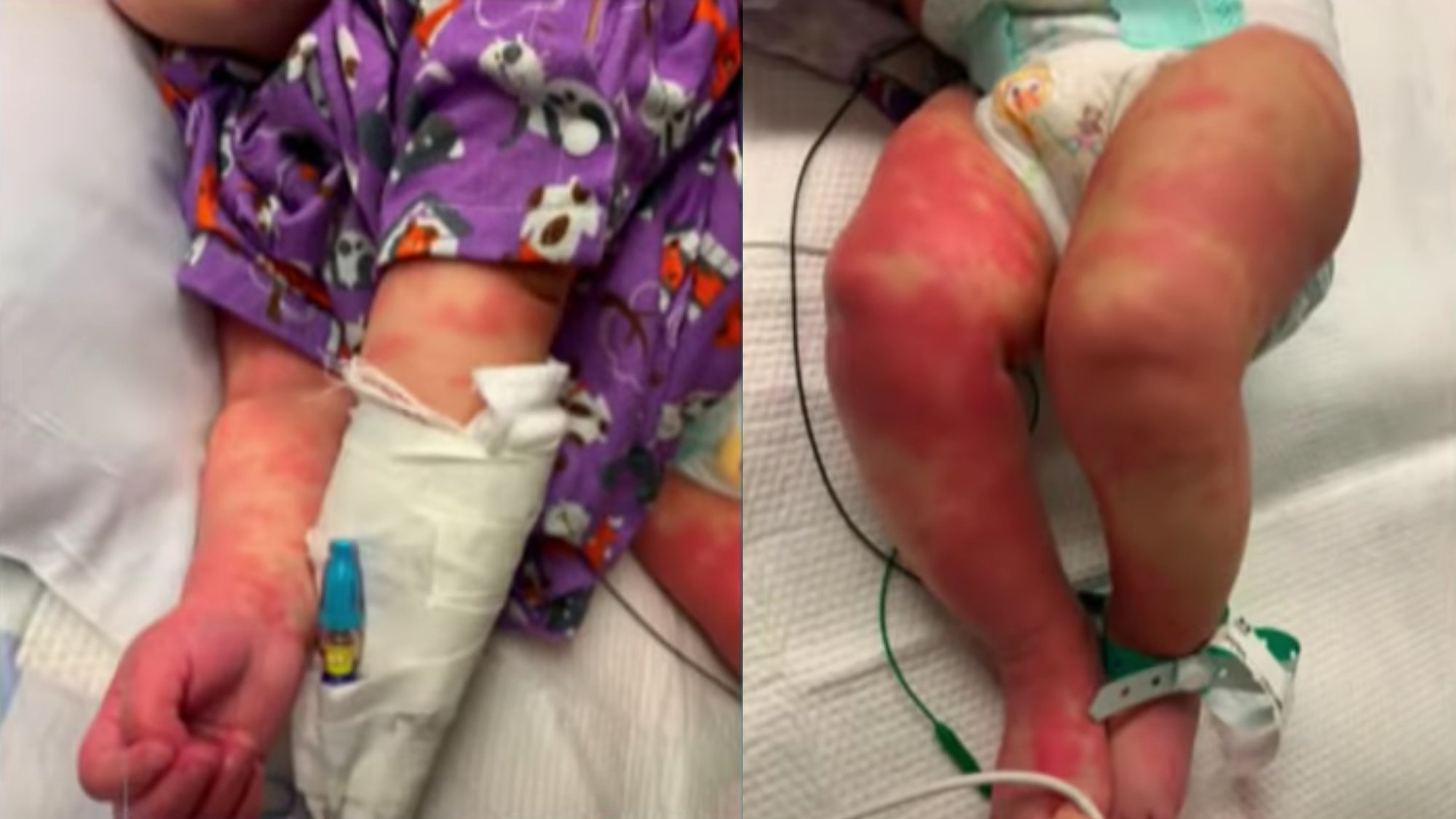 Images of Baby Zara's inflammatory rash