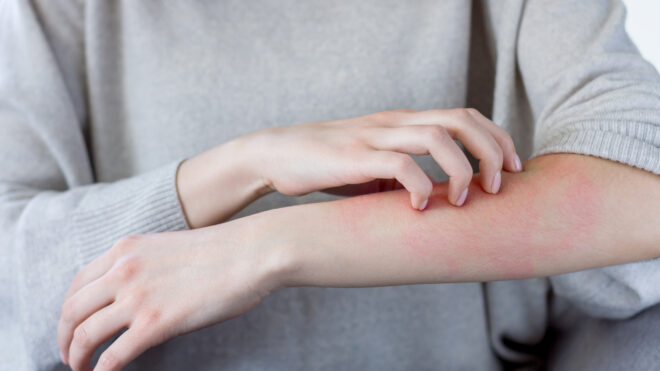 woman scratching her arm creating redness