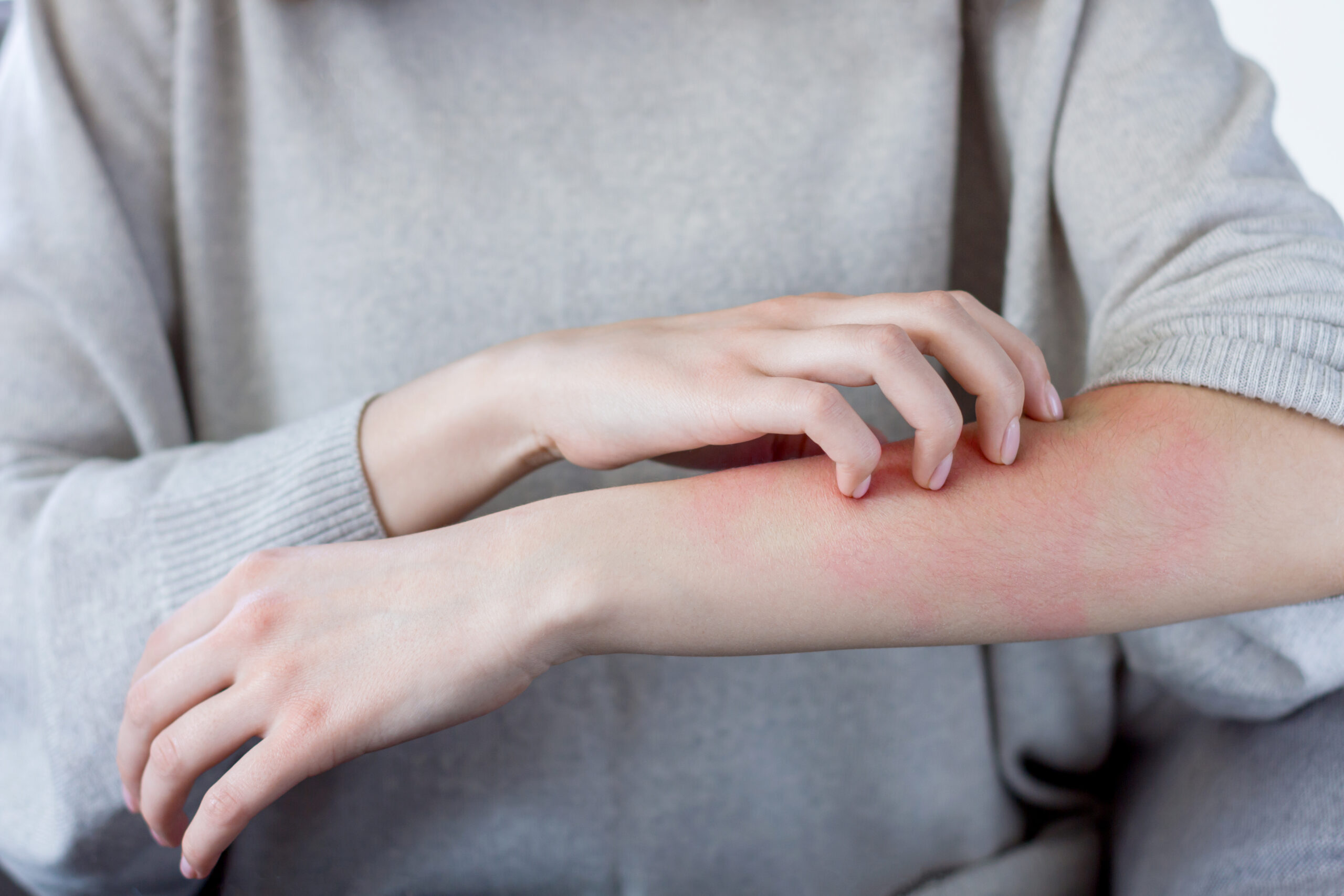 woman scratching her arm creating redness