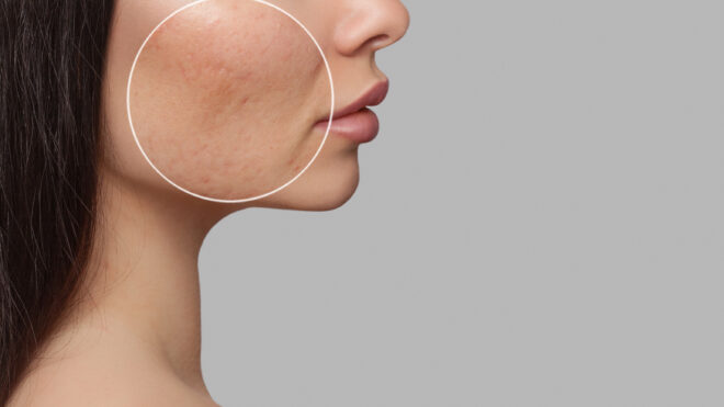 acne scars